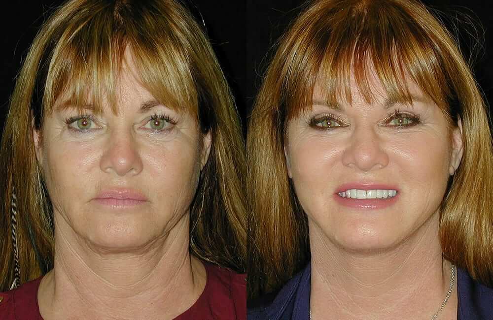 Jeana Keough Before and After