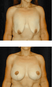 Dr. Ip Breast Lift Patient