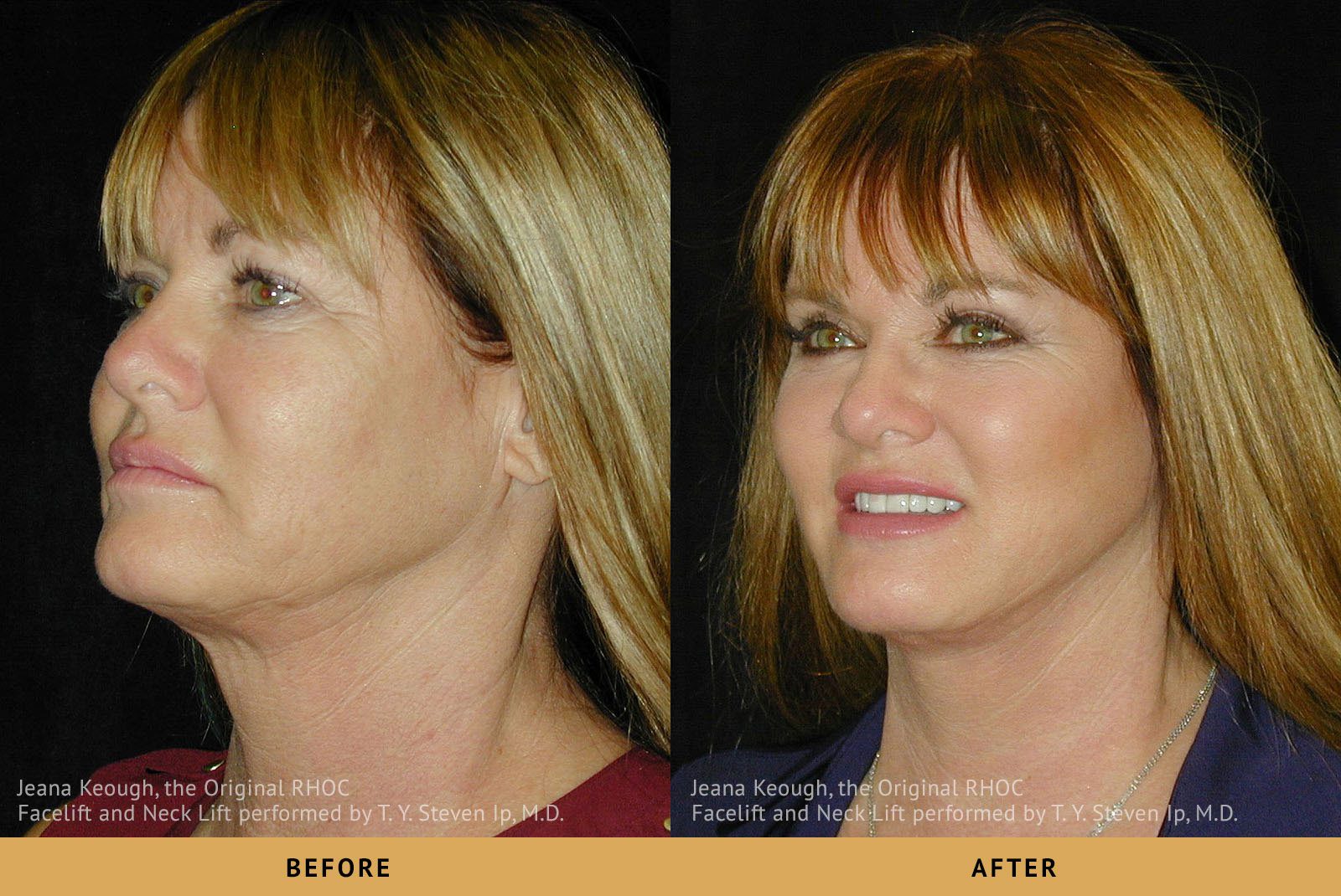 jeana keough real housewives of orange county RHOC Facelift and Necklift Side View