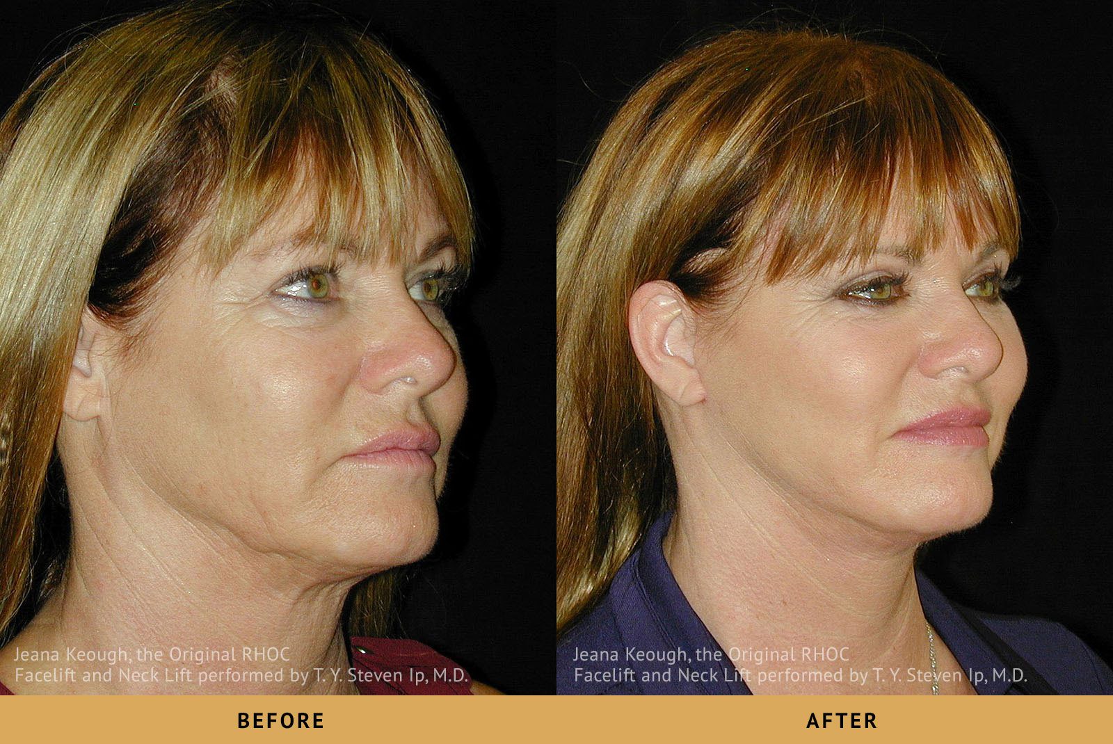 jeana keough real housewives of orange county RHOC Facelift and Necklift Right Oblique View