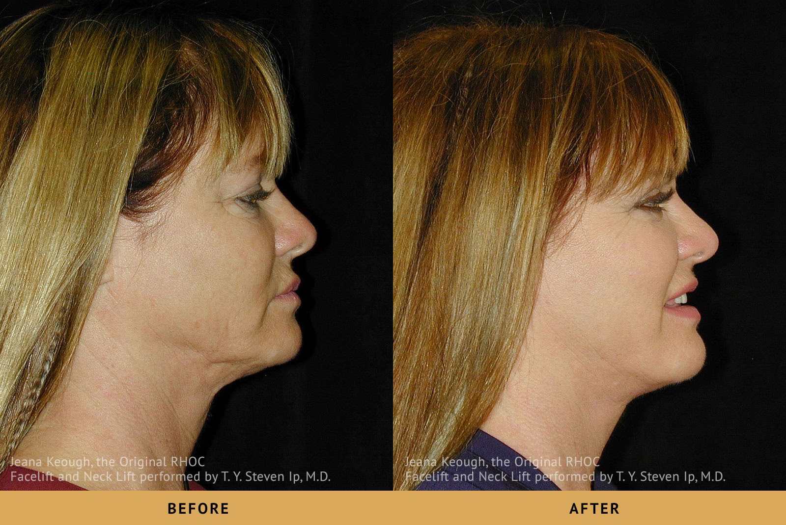 jeana keough real housewives of orange county RHOC Facelift and Necklift Right Profile View