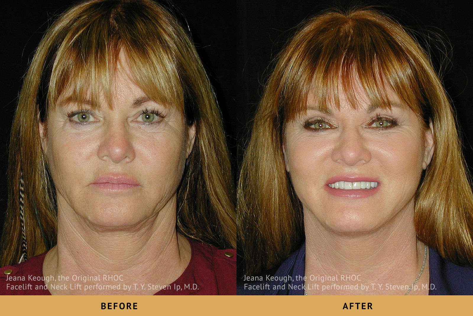 jeana keough real housewives of orange county RHOC Facelift and Necklift